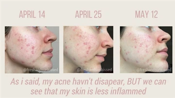 グアシャはにきびに役立ちますか